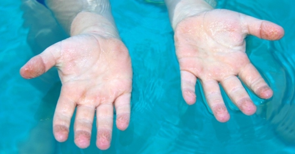 Pés antiderrapantes: nossos dedos se enrugam na água para não escorregarmos
